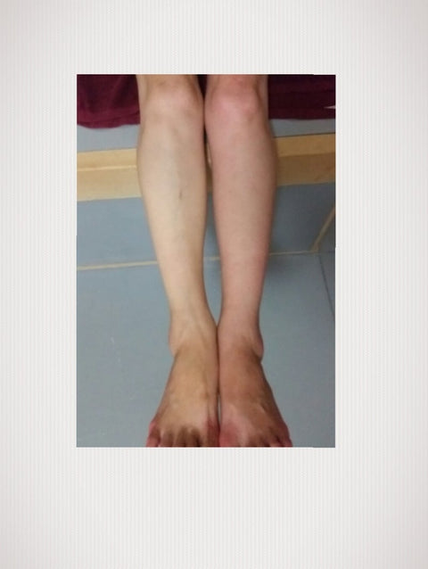 血流改善「うっ血」とは？